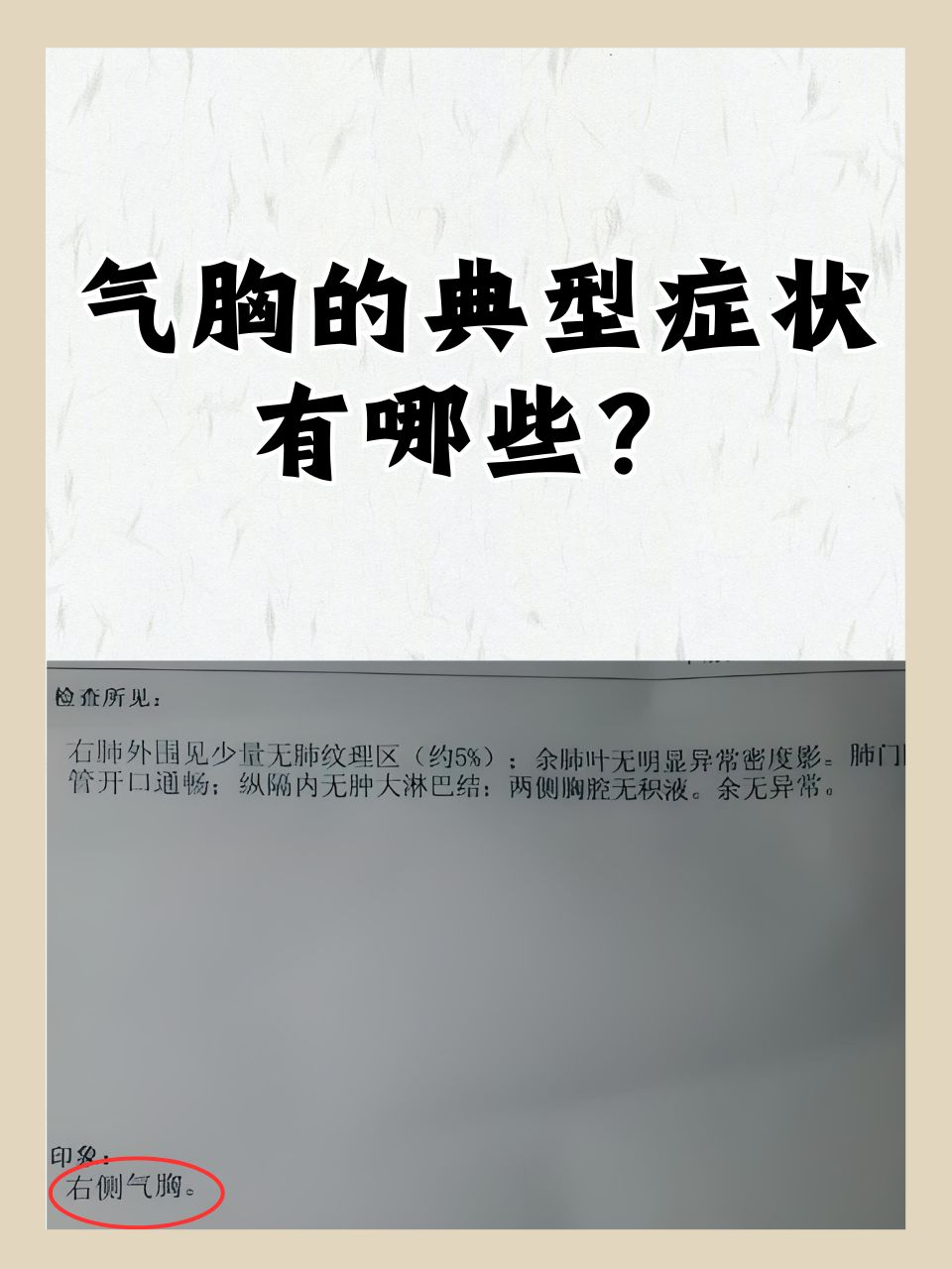 气胸严重吗?