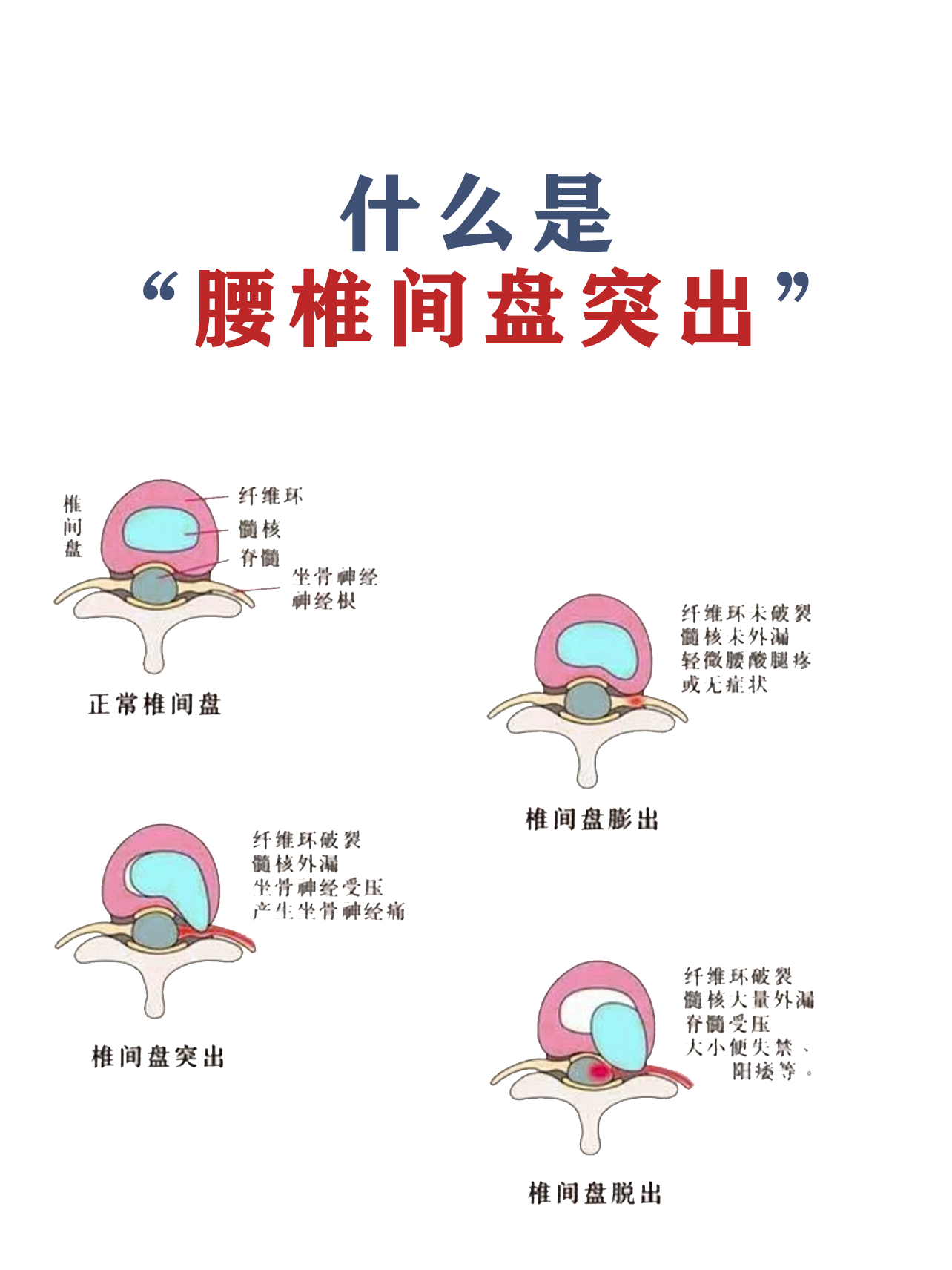 什么是腰椎小关节紊乱症