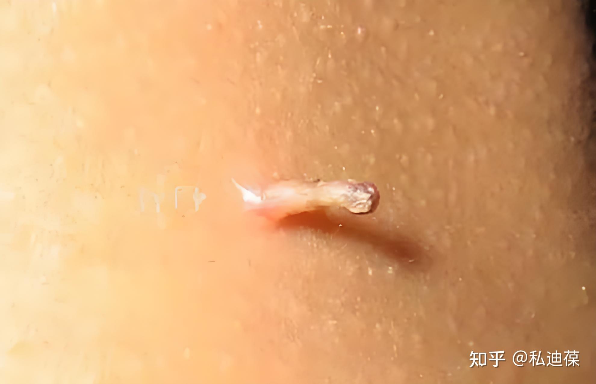 什么是宫颈赘生物