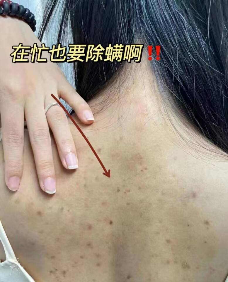 背上长痘痘怎么办