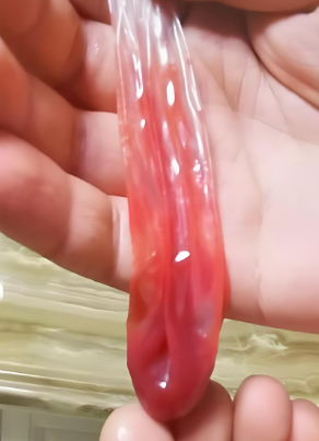 精液带血是什么回事