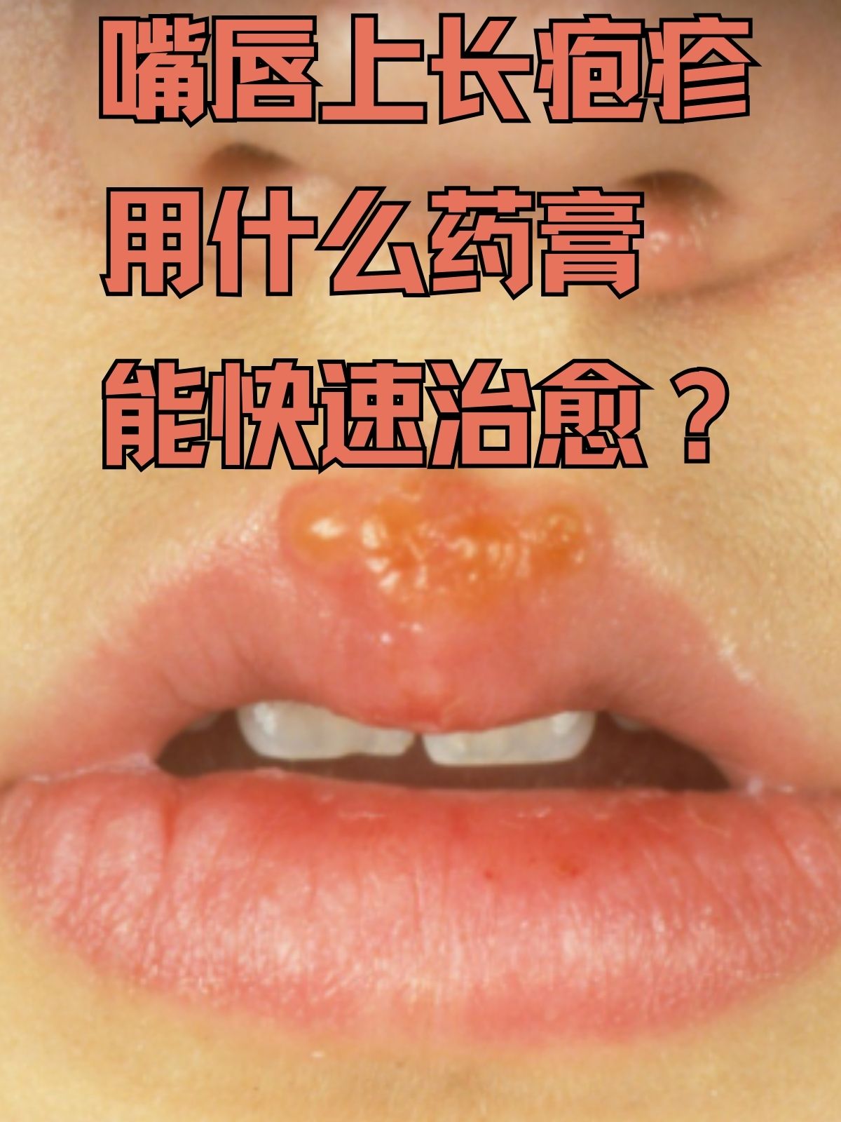 嘴唇起泡怎么办