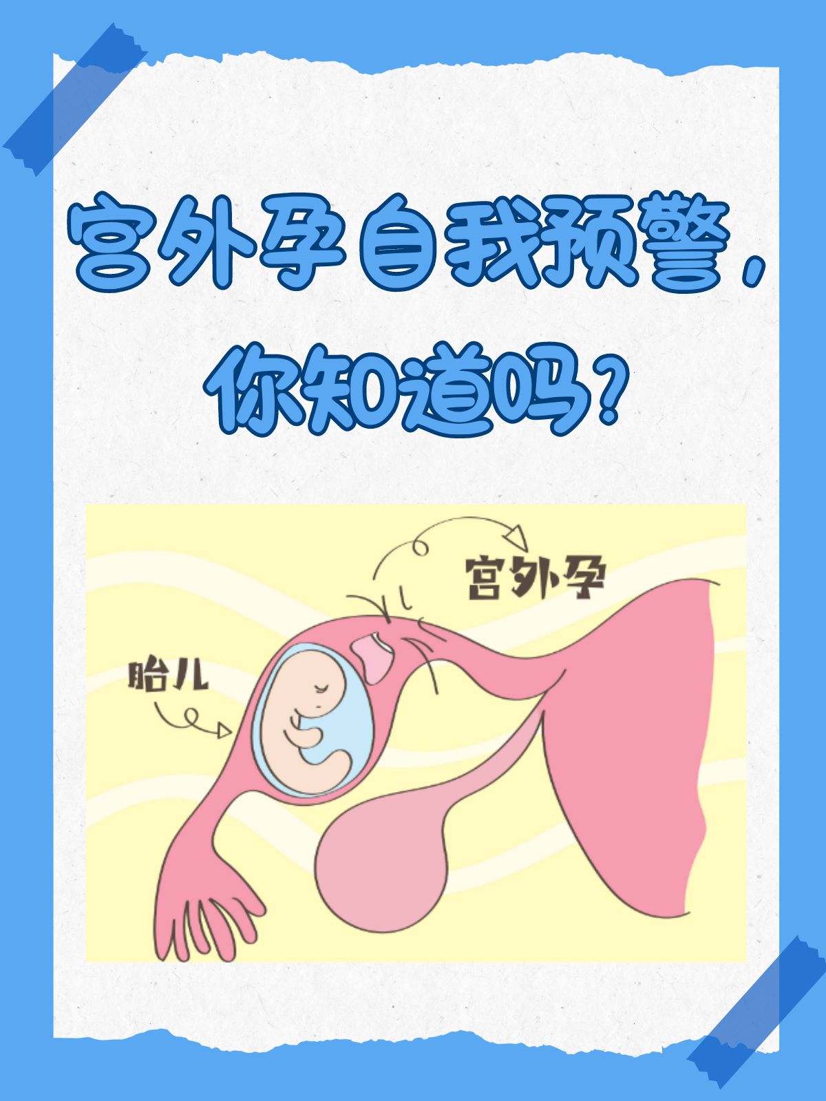 宫外孕危险吗?