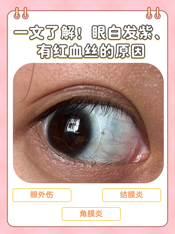 眼白发红怎么引起的