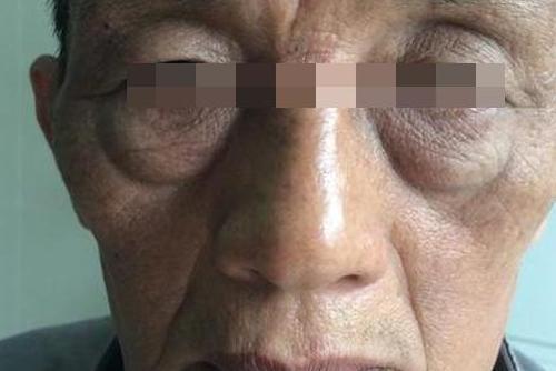 肝硬化晚期的症状