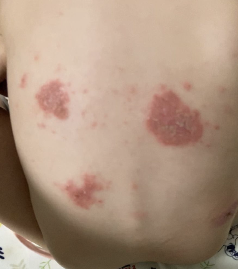 身上起红疙瘩
