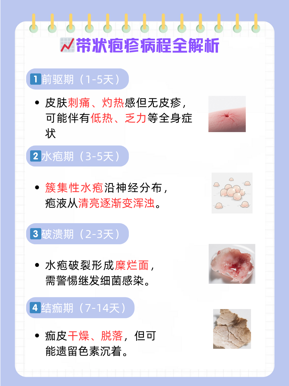 带状疱疹如何治疗