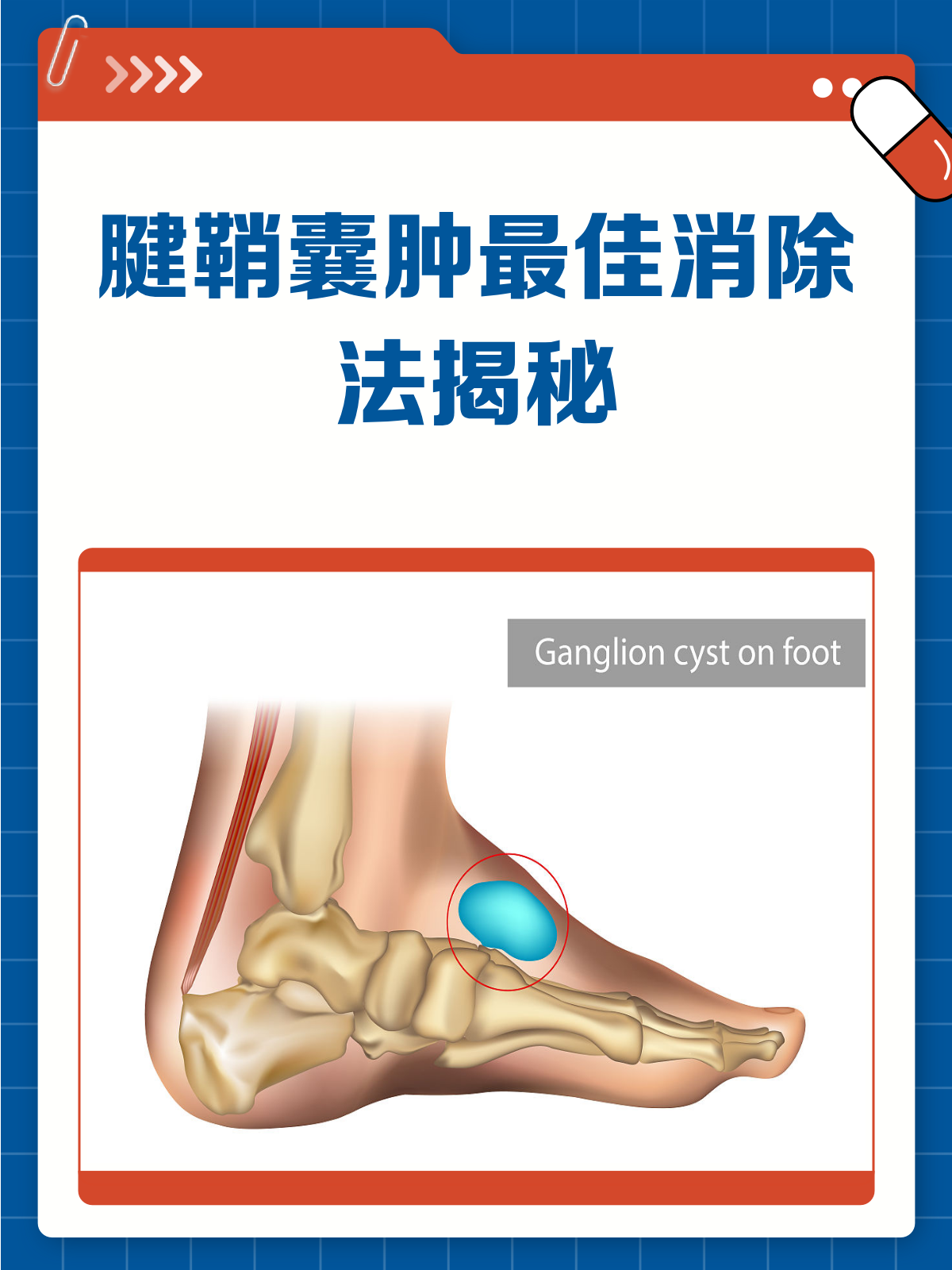 腱鞘囊肿怎么治最好