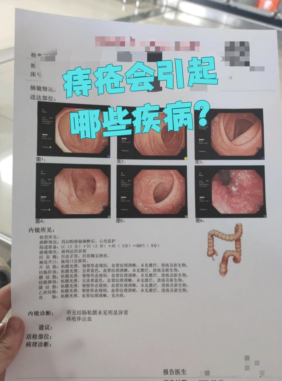 早期直肠炎有哪些症状