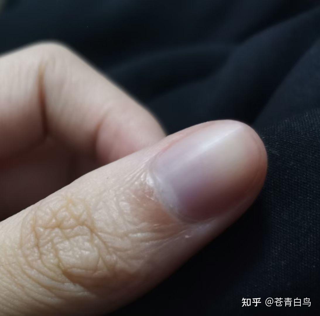 指甲有点发紫是怎么回事