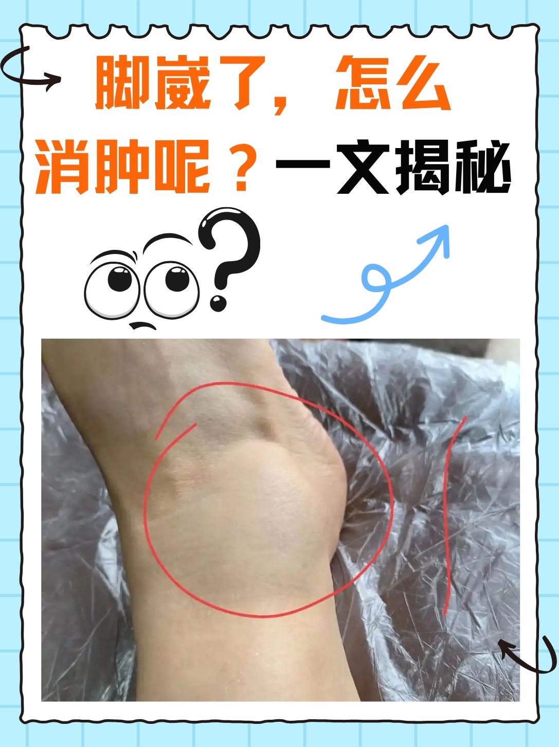 打球崴脚,如何快速恢复