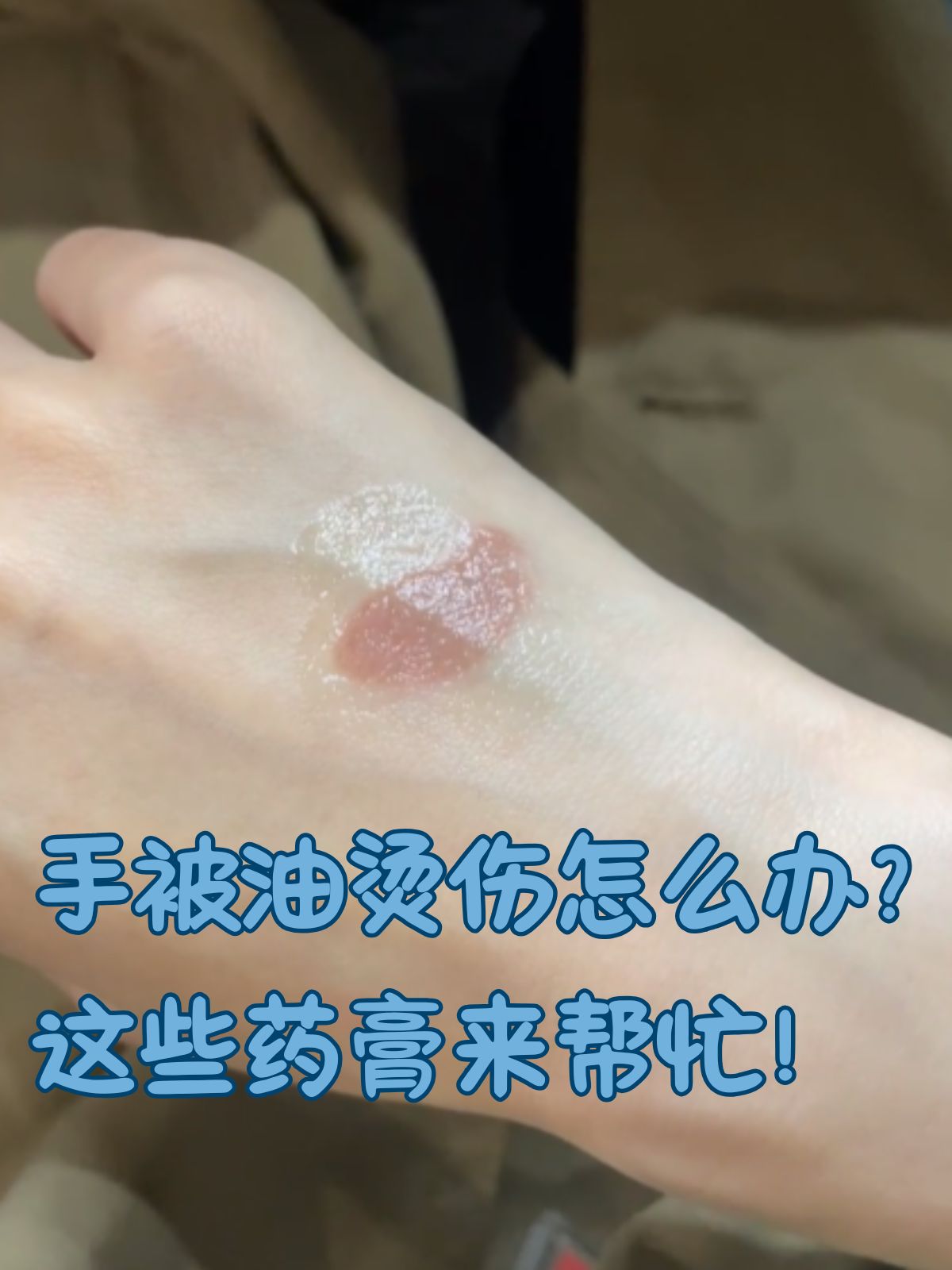 被油烫伤起泡怎么办