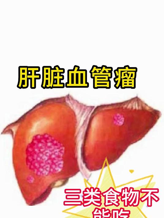 肝血管瘤应该注意哪些?