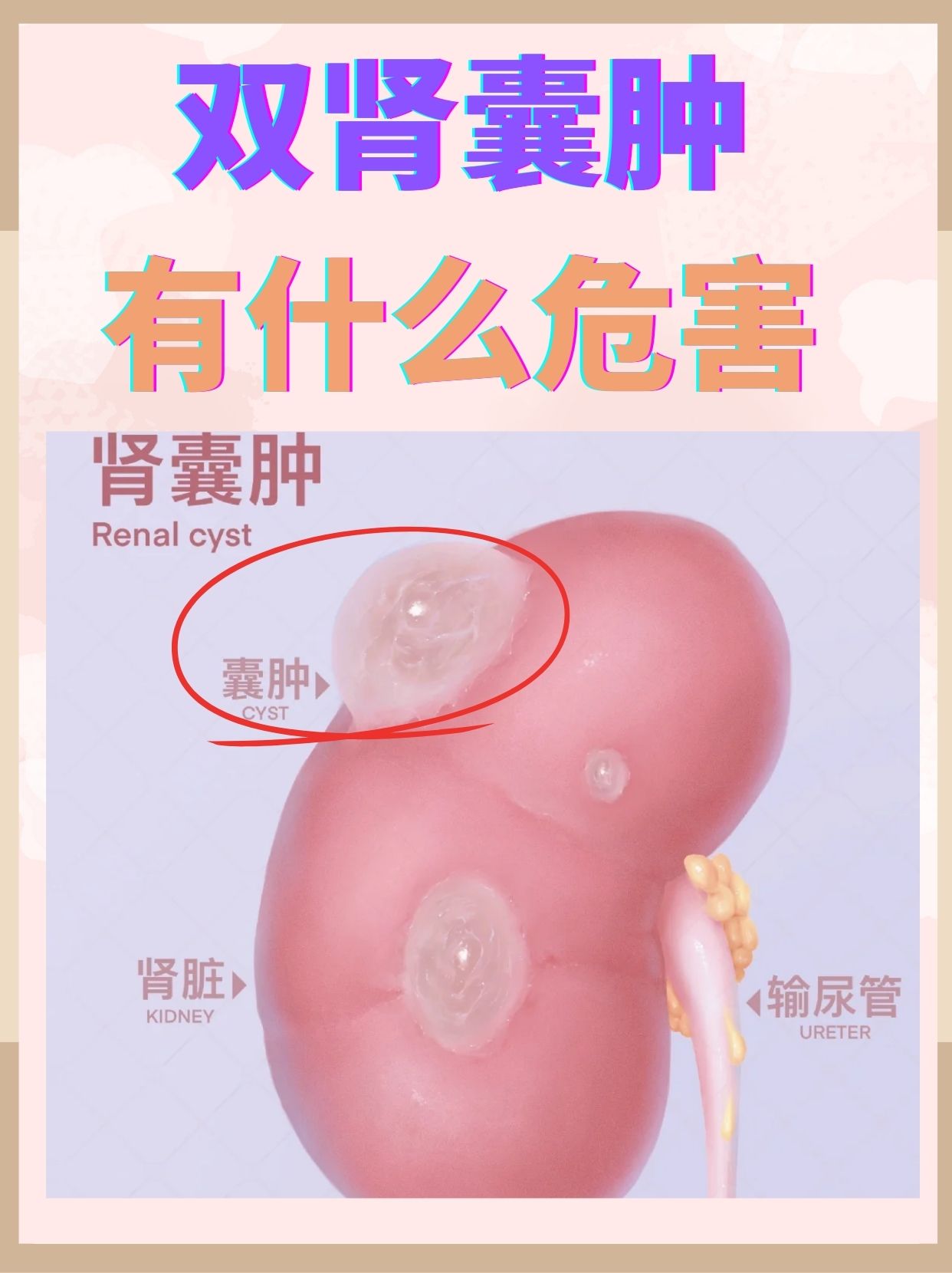 女性左肾囊肿能自愈吗