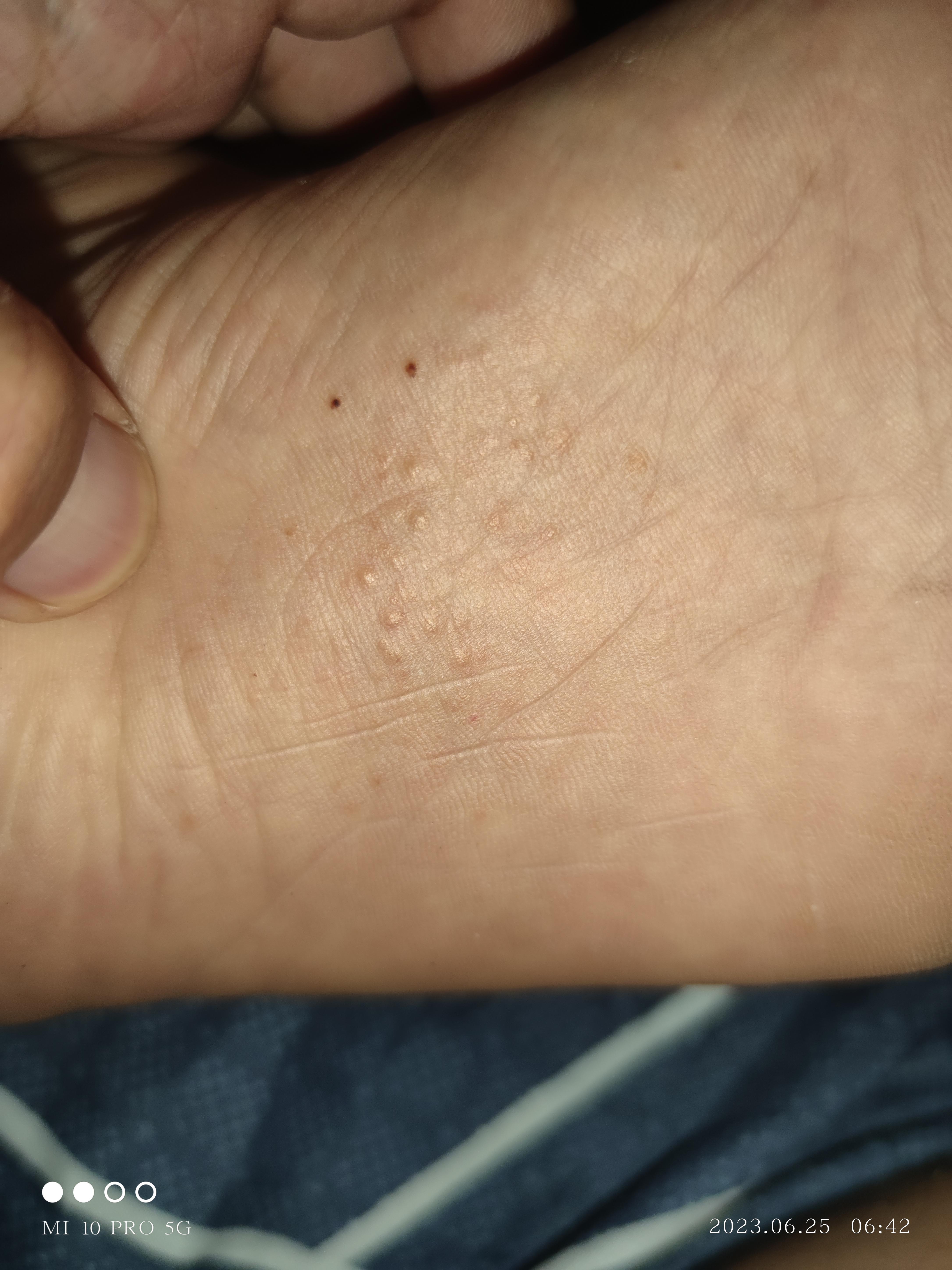 脚底长好多小疙瘩,很痒