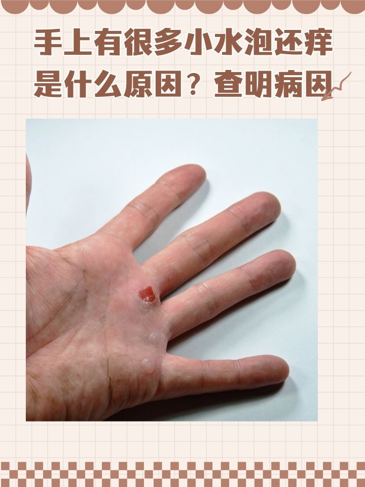 手指起小水泡是什么原因