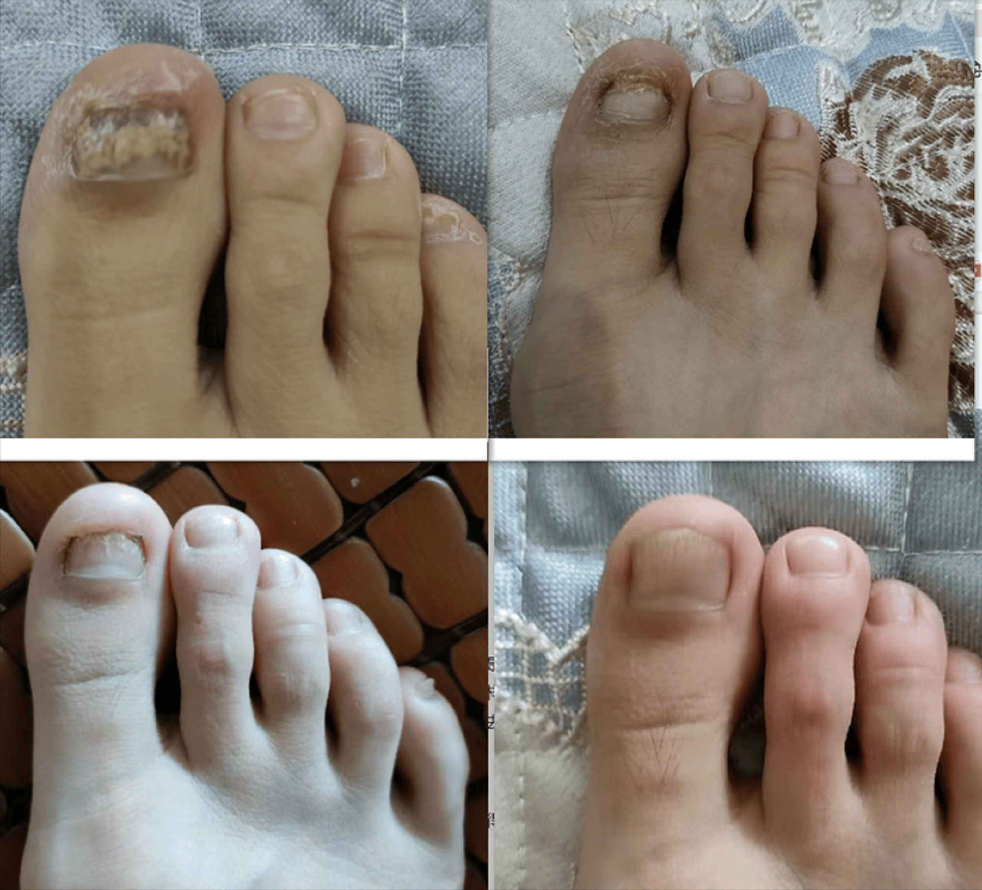 灰指甲早期症状有哪些?