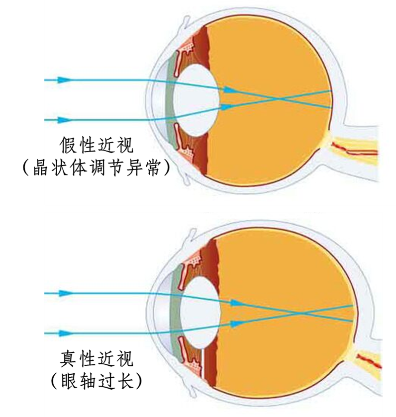 远视眼具体是怎么形成的