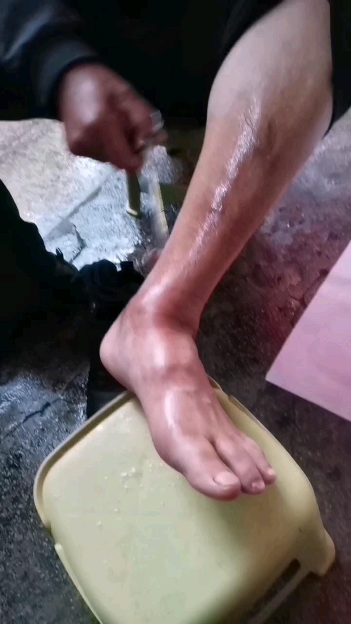 手指浮肿是什么原因