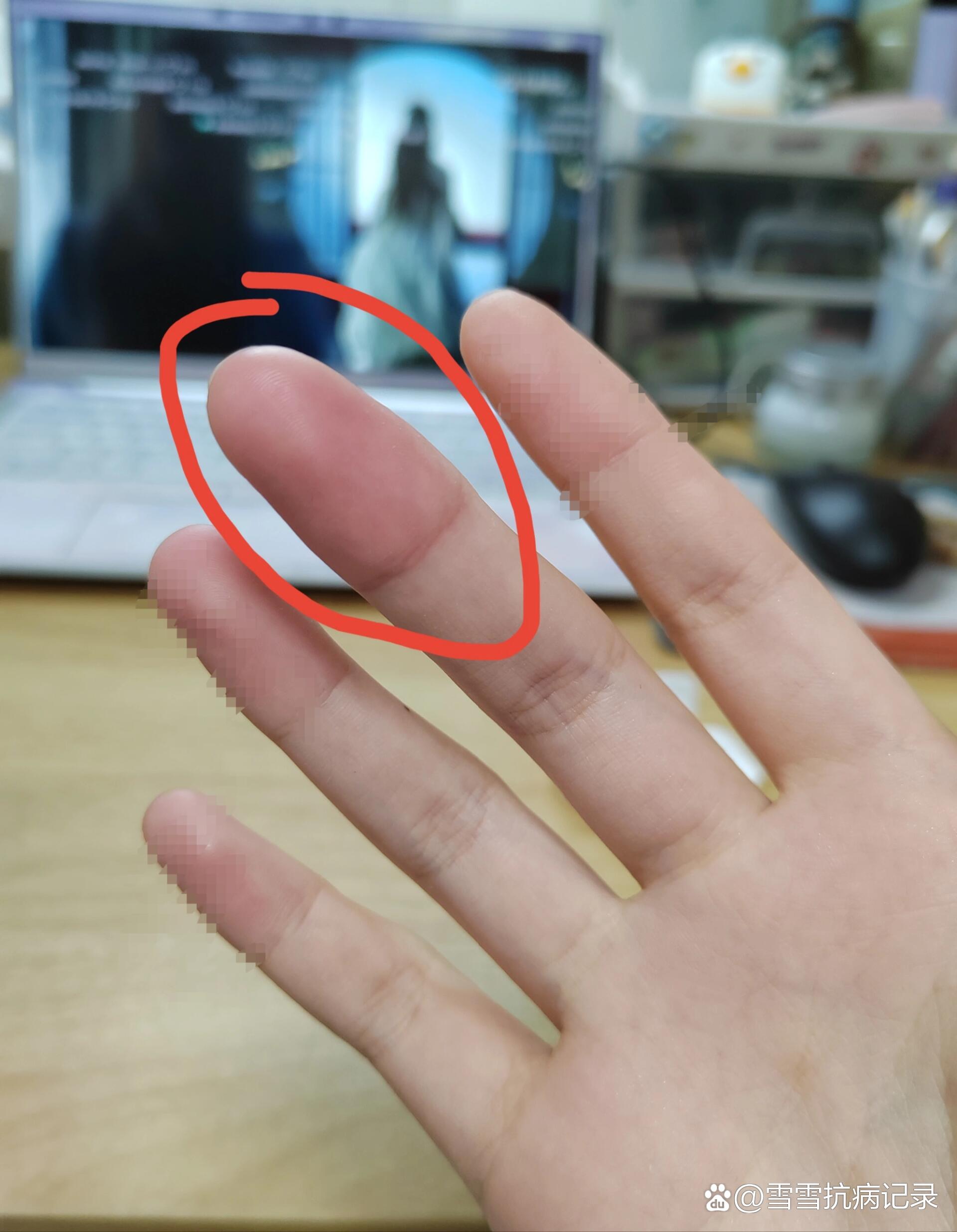 手指浮肿是什么原因