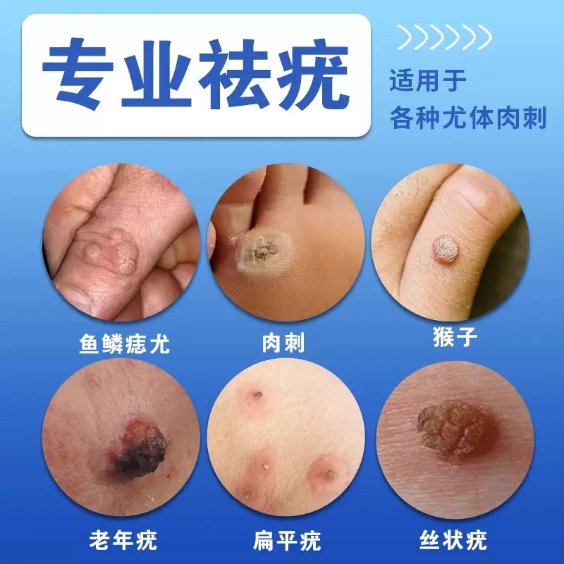 手上长猴子怎么去掉