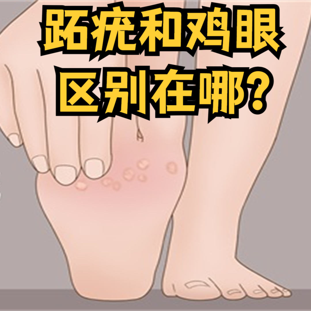 鸡眼和跖疣的区别