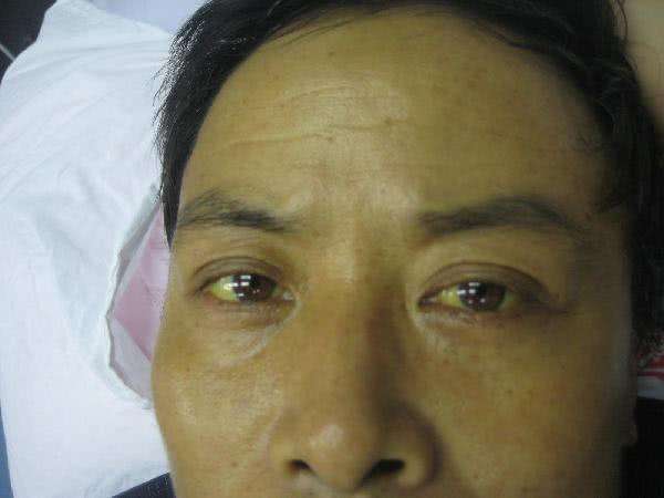 肝癌的早期有哪些症状