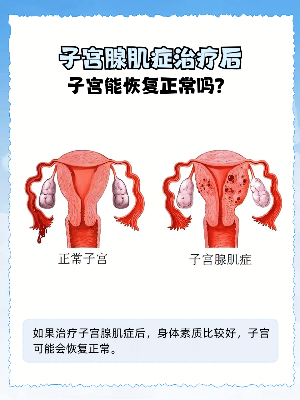 什么是子宫腺肌症?