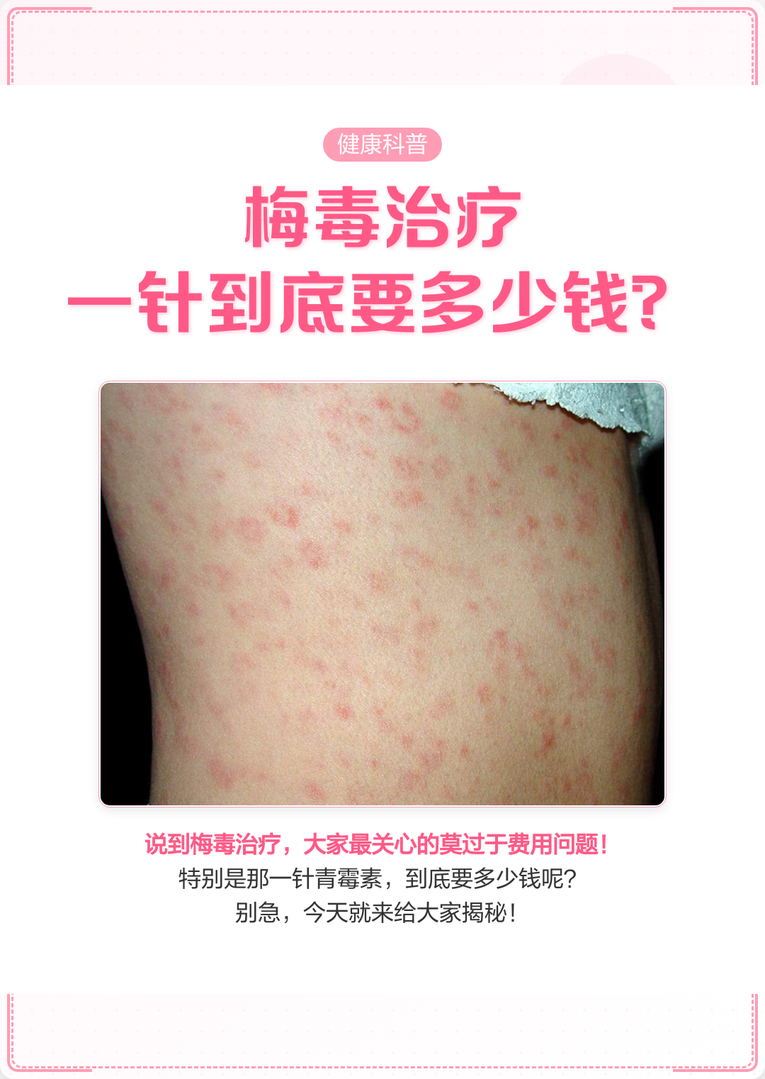 梅毒多久可以排除呢?
