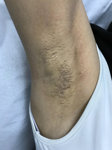 胳肢窝里面长小疙瘩怎么回事