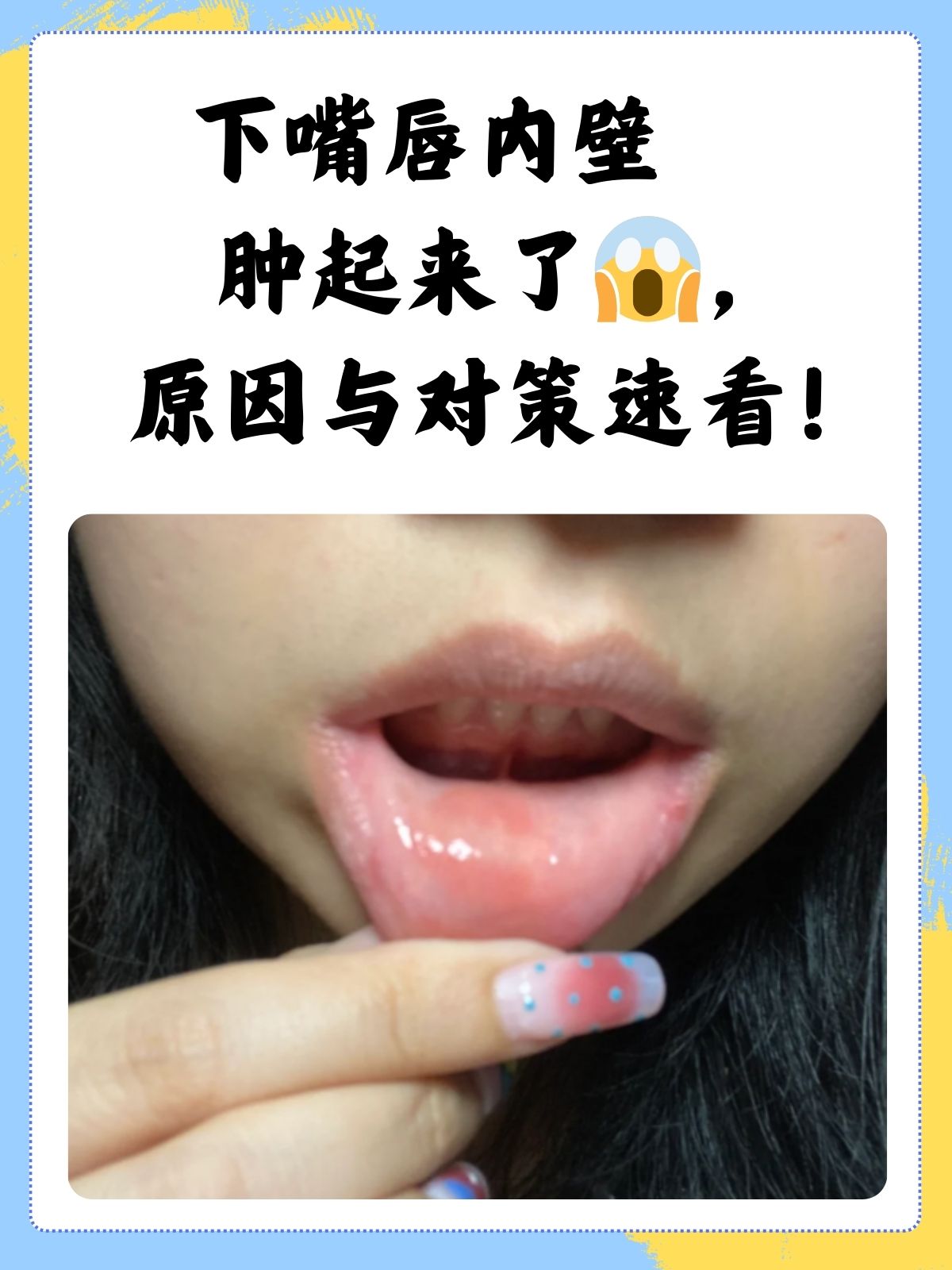 嘴唇突然肿了怎么回事?