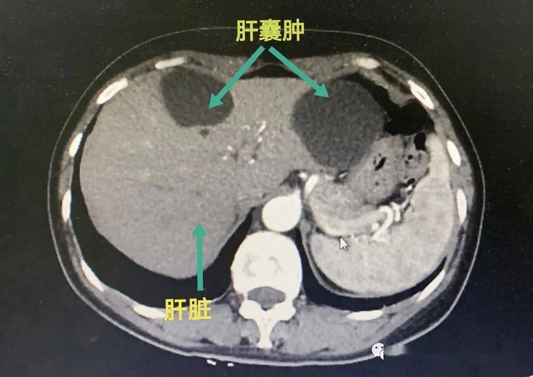 肝囊肿是什么?