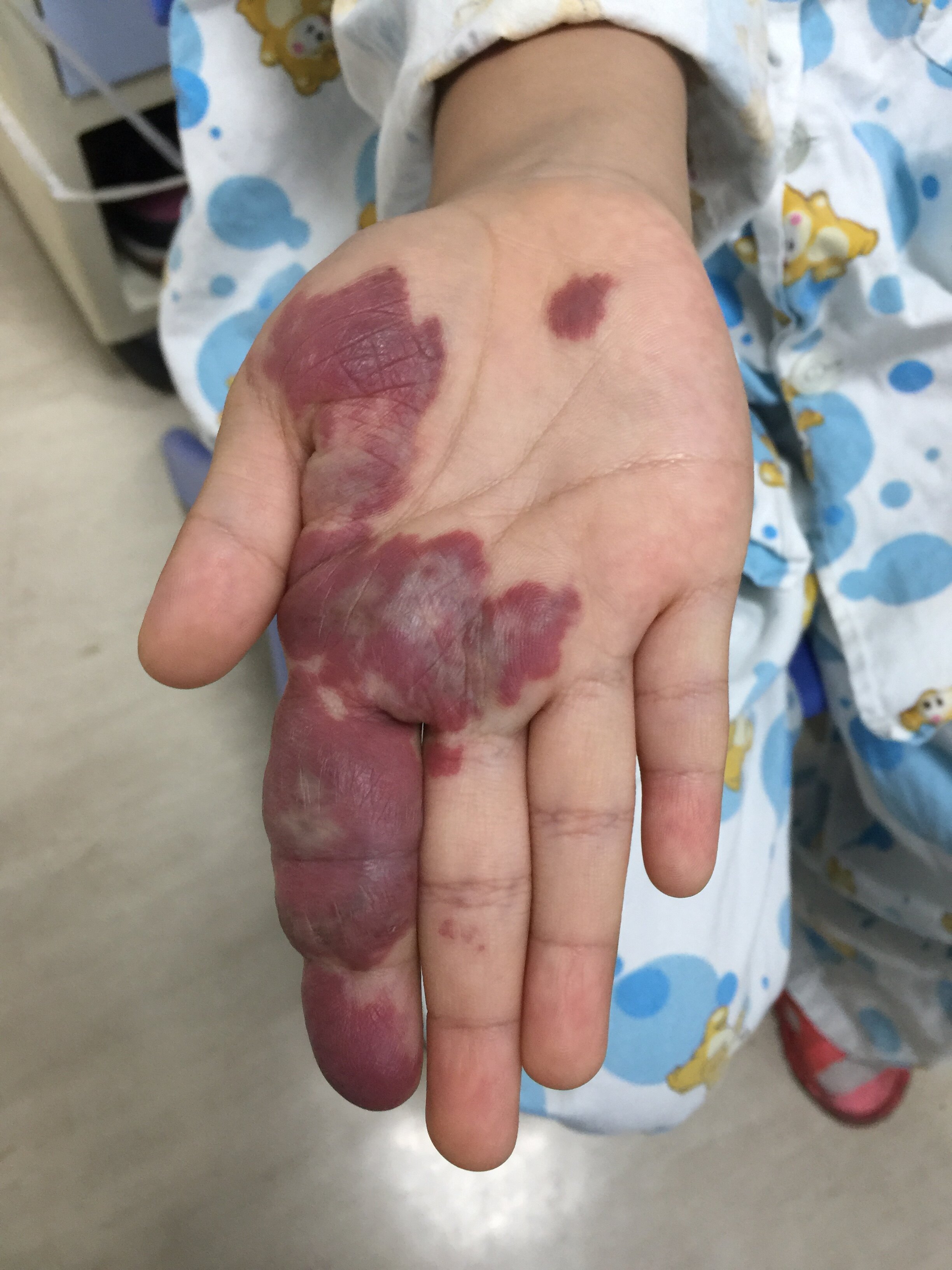 血管瘤需要手术吗?