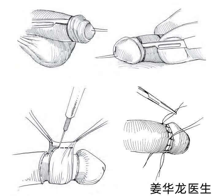 包皮粘连分离术