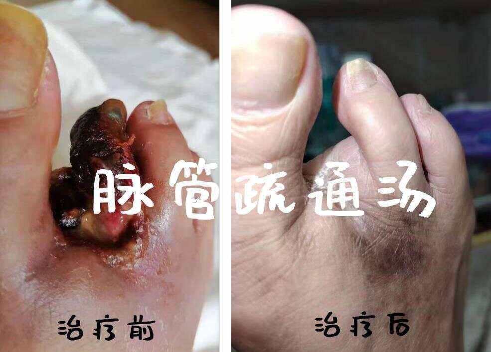 静脉炎怎么治疗最有效?