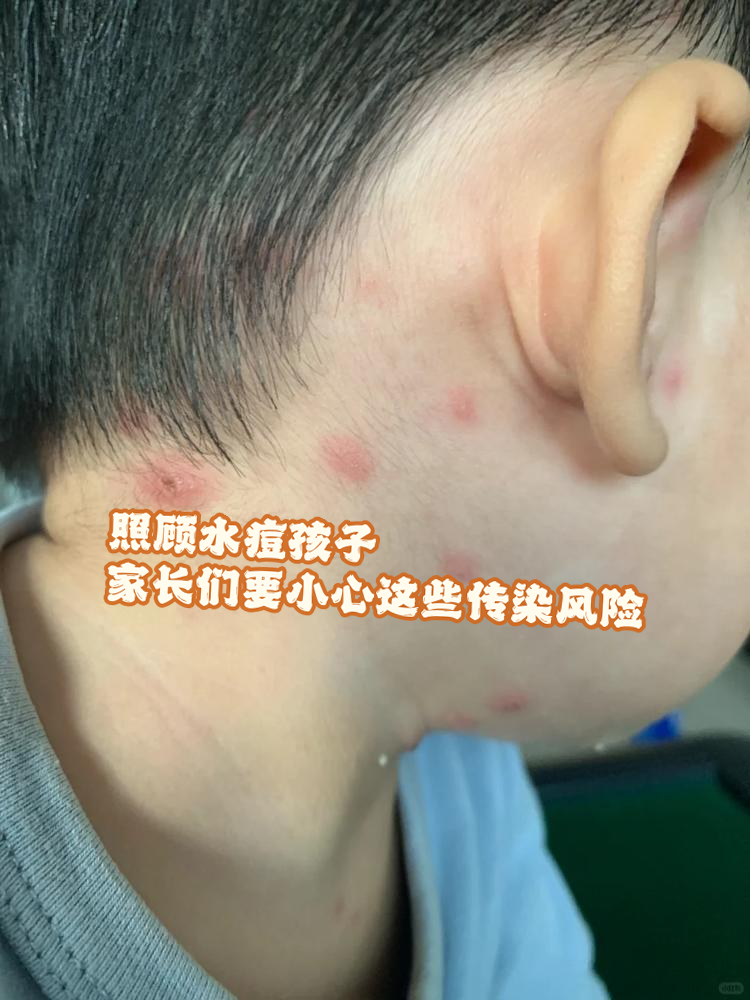 孩子出水痘怎么办