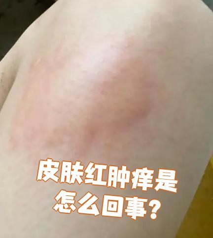 皮肤发红怎么回事?