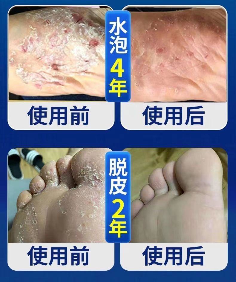 真菌感染怎么快速治疗