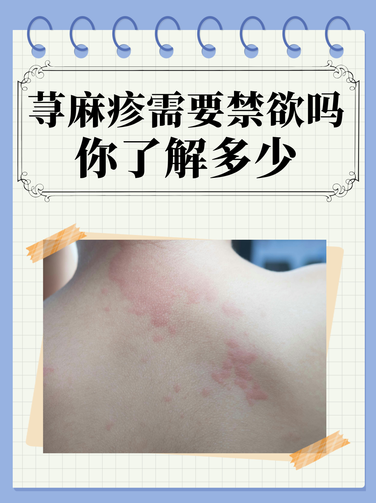 慢性荨麻疹的起因