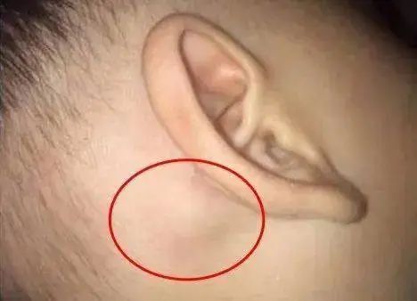 耳后淋巴结肿大