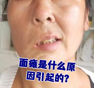 面神经瘫痪是怎么回事