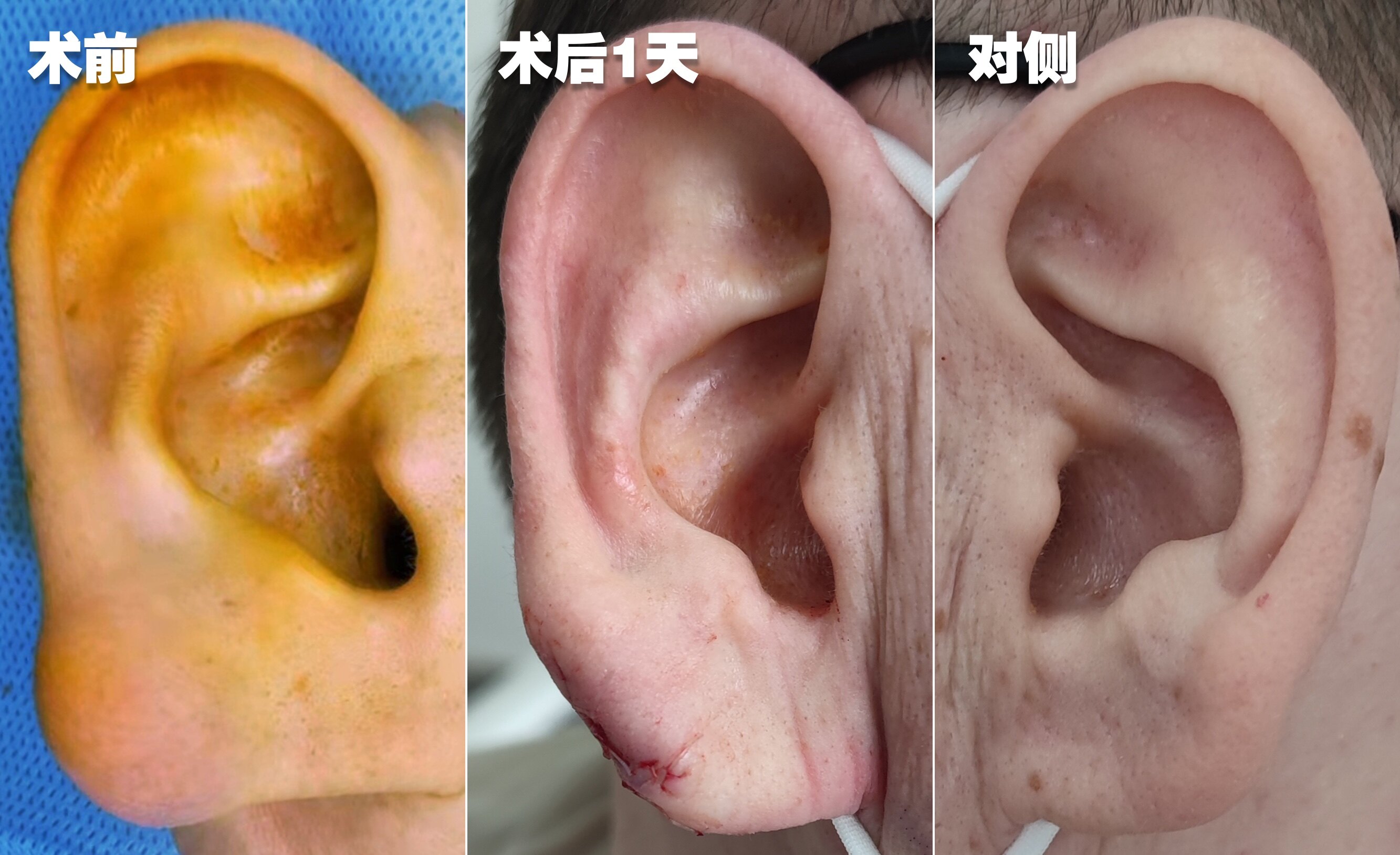 耳廓囊肿能根除吗?