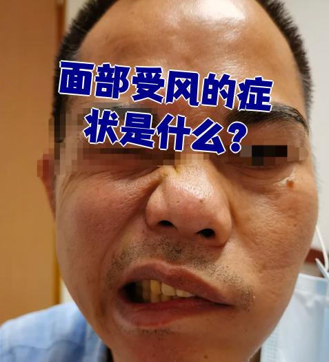 面部神经炎的症状