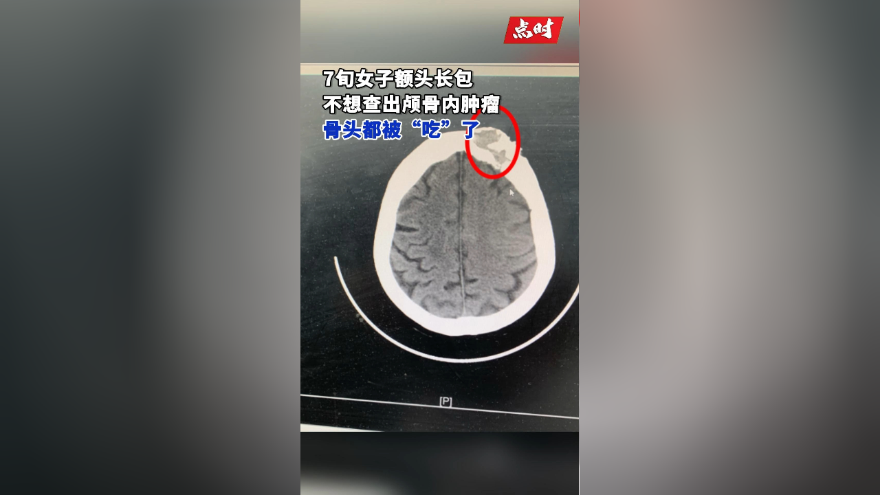 枕骨骨瘤严重吗