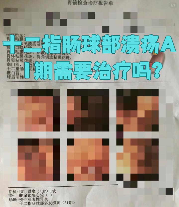十二指肠球部溃疡严重吗