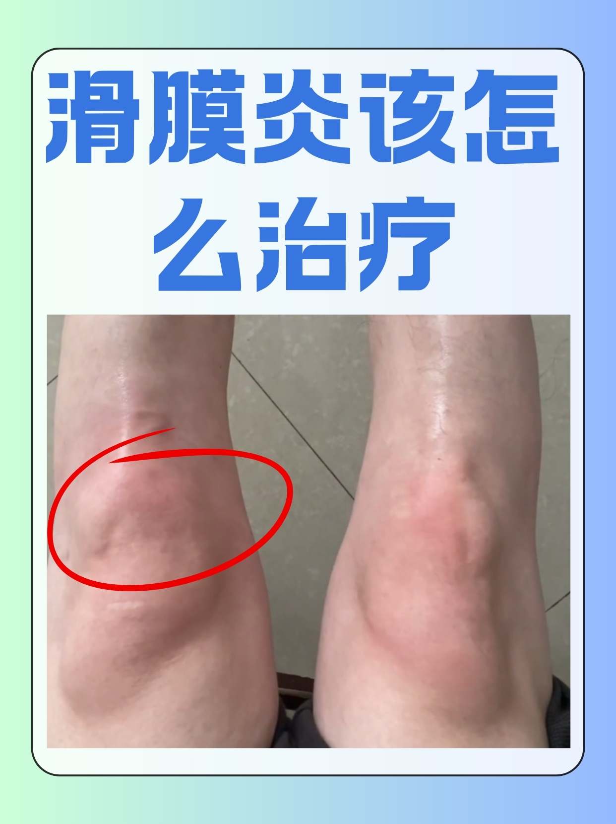 滑膜炎是什么原因?
