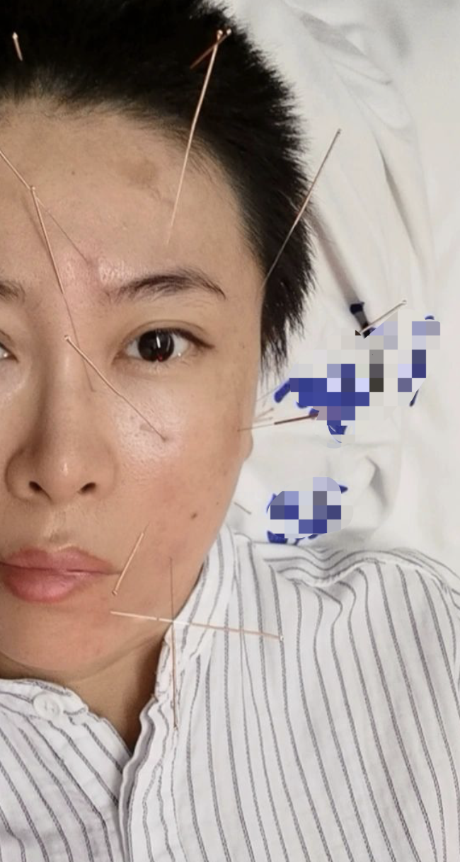 得了面瘫一般多久能康复呢