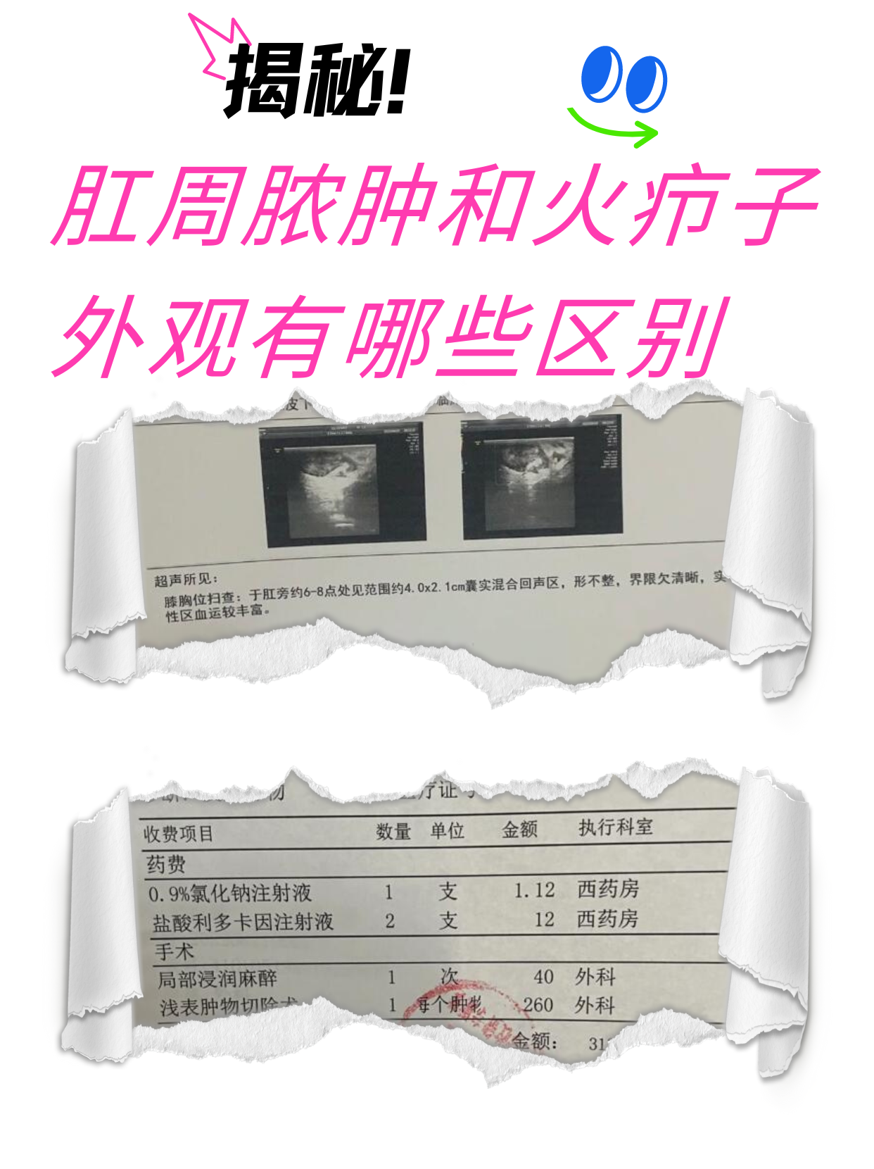 肛周脓肿形成的原因有哪些?