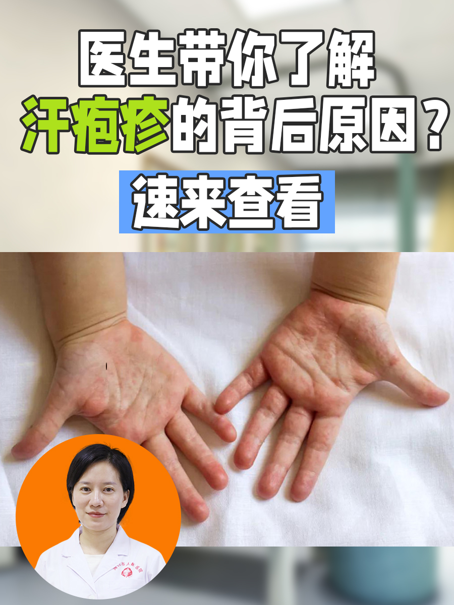 手上长汗疱疹怎么治疗