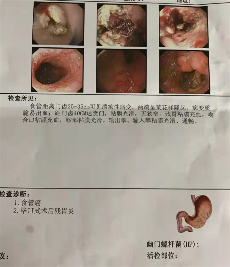 食道癌术后大约可以活多久